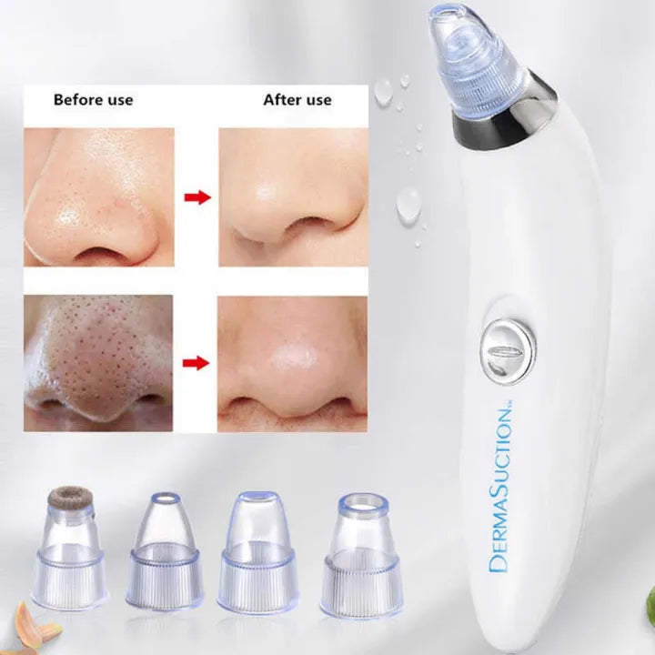 Blackhead, Whitehead Removal Machine Derma Suction 4 In 1 Black Head, whitehead Remover Machine Acne Pimple Pore Cleaner Vacuum Tool