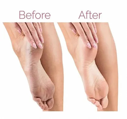 Rechargeable foot scrubber device