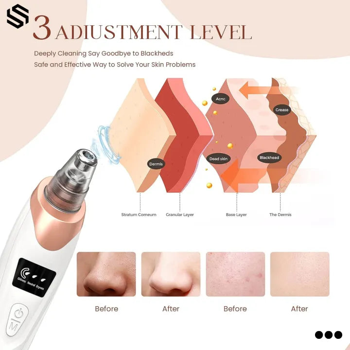 Blackhead, Whitehead Removal Machine Derma Suction 5 In 1 Black Head, whitehead  Remover Machine Acne Pimple Pore Cleaner Vacuum Tool